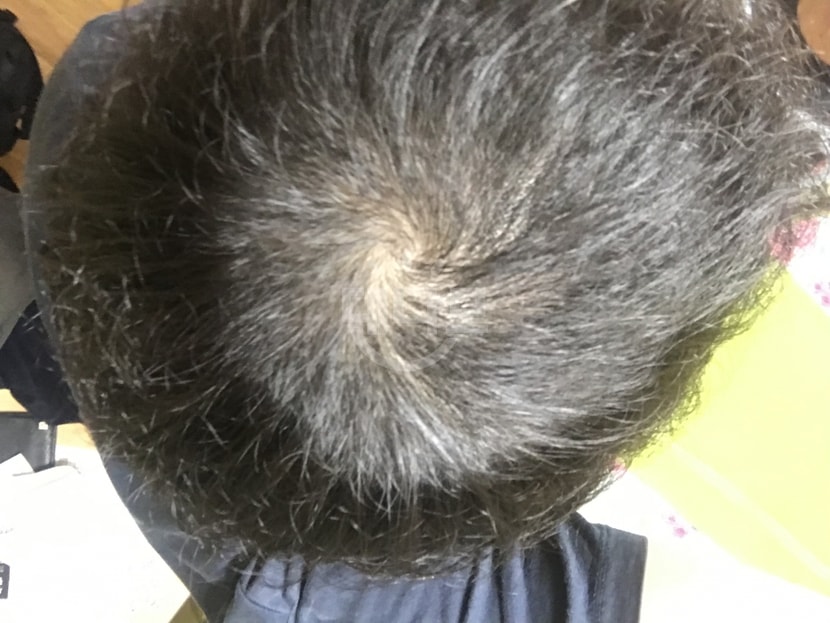 모나페시아 복용 52일차