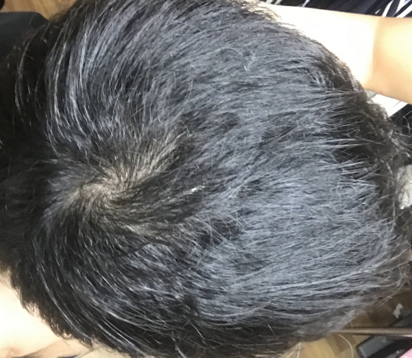 모나페시아 복용 90일차(현재)