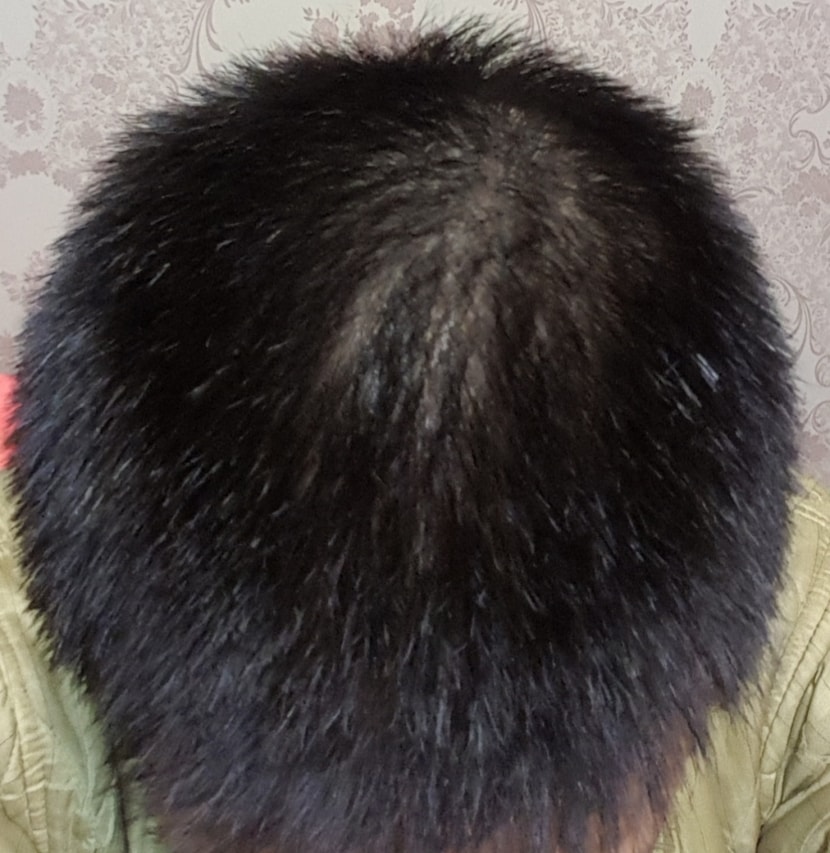 머리가 짧아서 그런건지 뭔가 두피가 비춰보이는것 같아서 사진 찍어봤다가 충격받았습니다. 충격받아서 엄마한테 사진보여주면서 내 머리가 진짜 이렇게 보이냐고 여쭤봤더니 하나도 저렇게 안보인다고 너사진 맞냐고 하시더라구요..