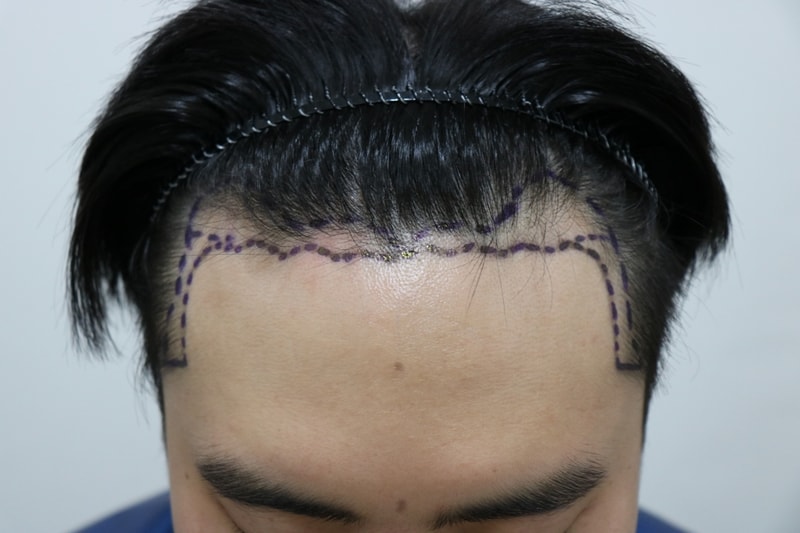 수술전디자인.JPG