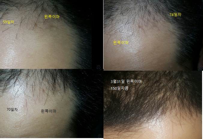 왼쪽이마 정리본 1.png