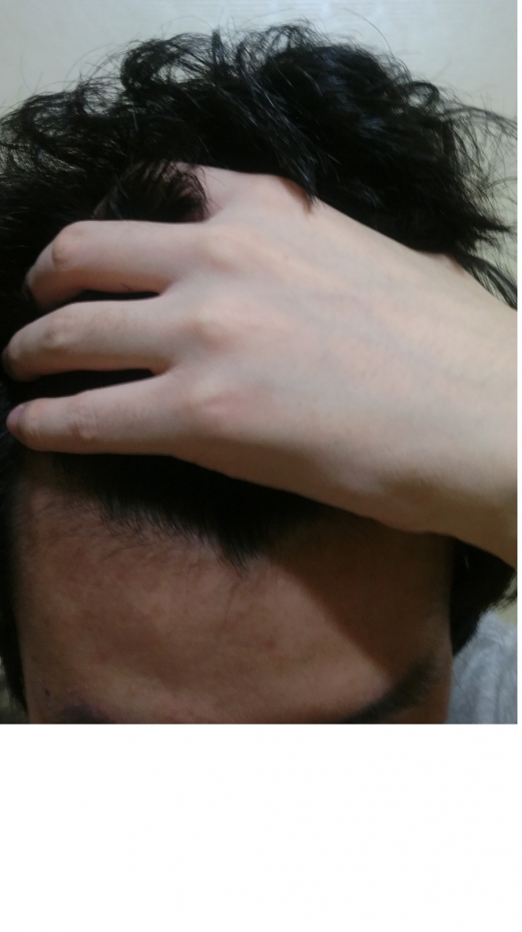 앞머리올렷을때.jpg