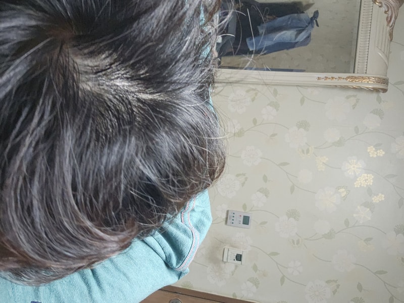 다시 올립니다. 탈모인지 좀 봐주세요.