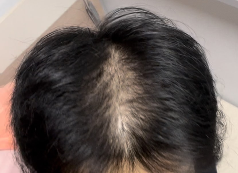 탈모