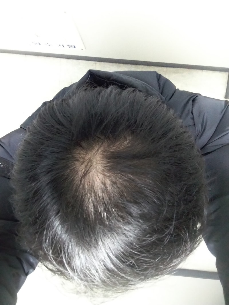 탈모2.jpg