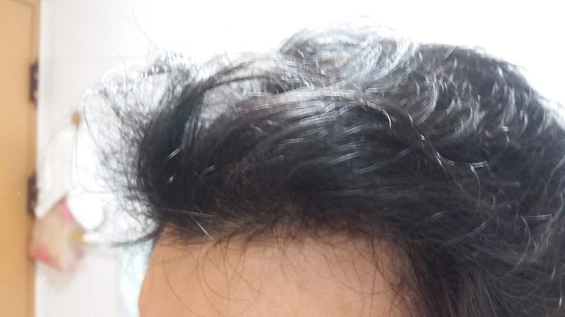 9월 머리 감기전 m자(지루성은 사라짐)