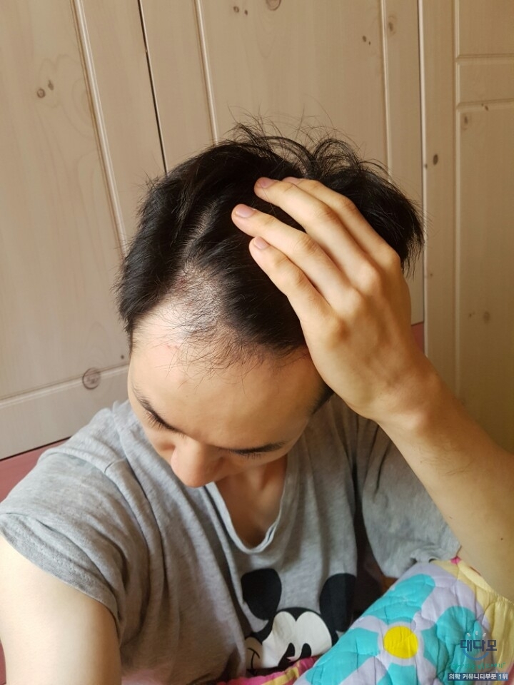 3개월 엠자 좌우측1.jpg