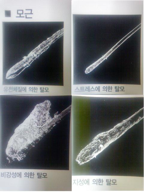 탈모원인.JPG