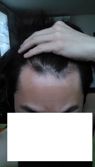 15년도 상반기 이식 전