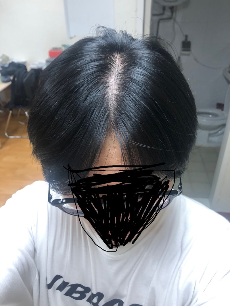 탈모2.jpg