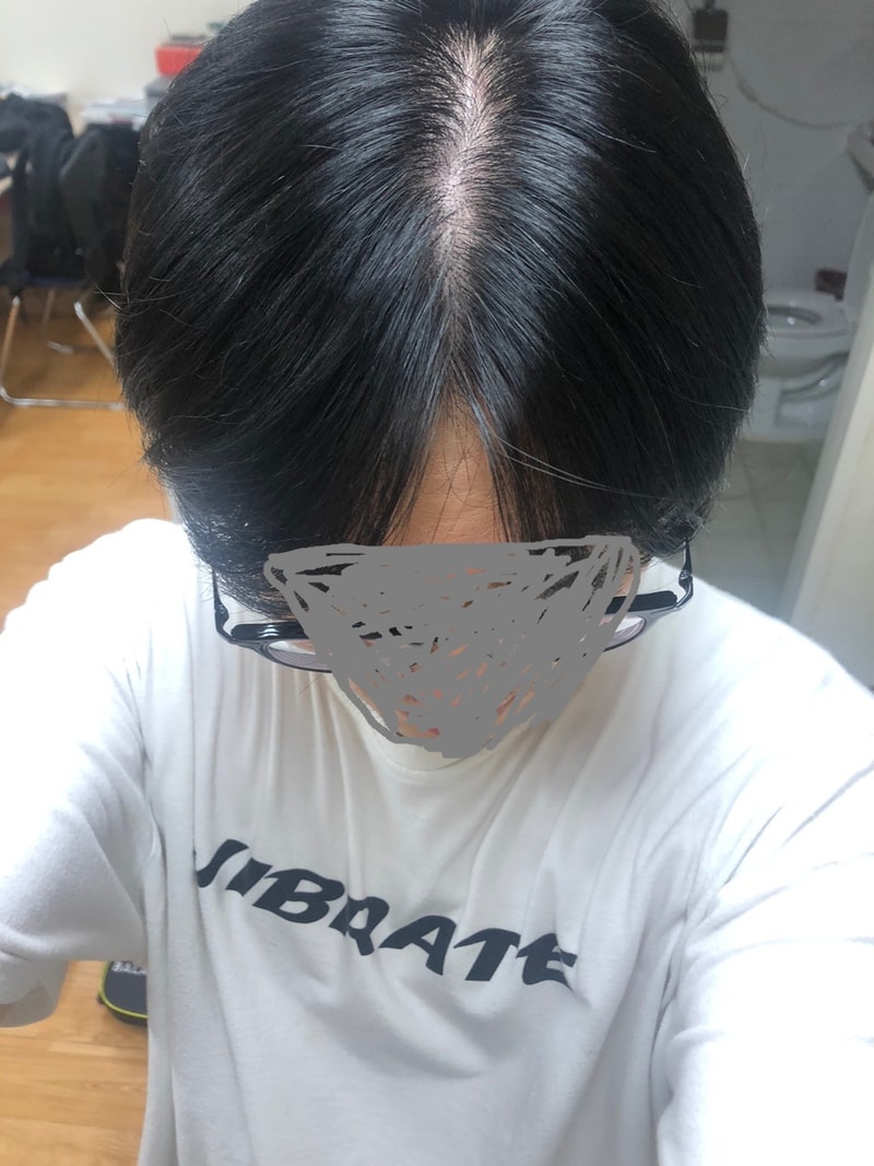 탈모1.jpg