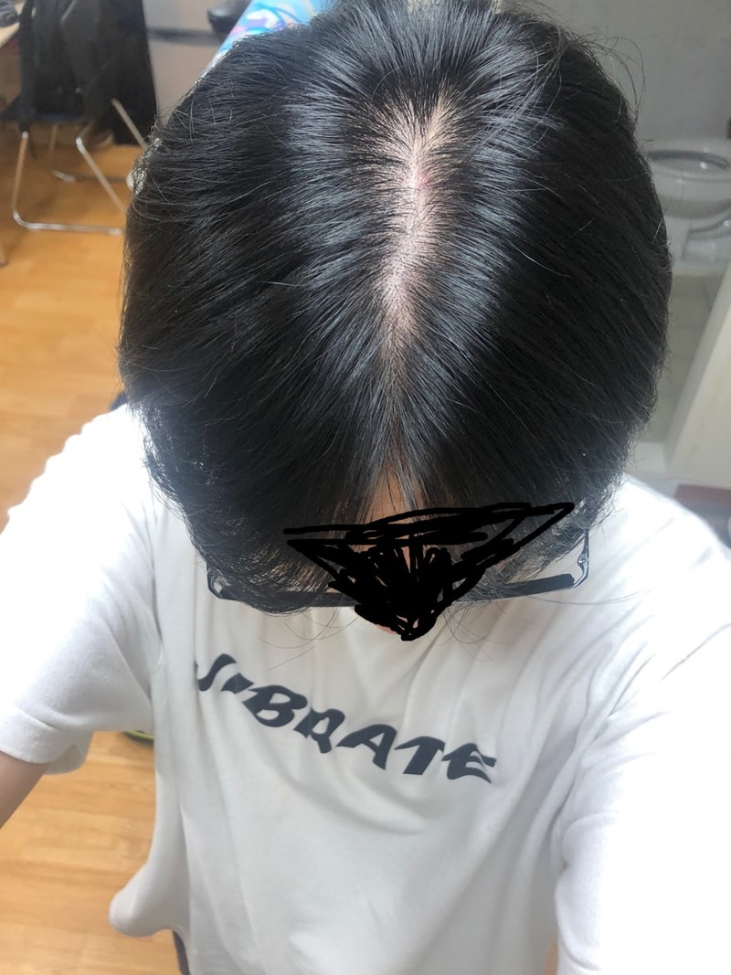 탈모3.jpg
