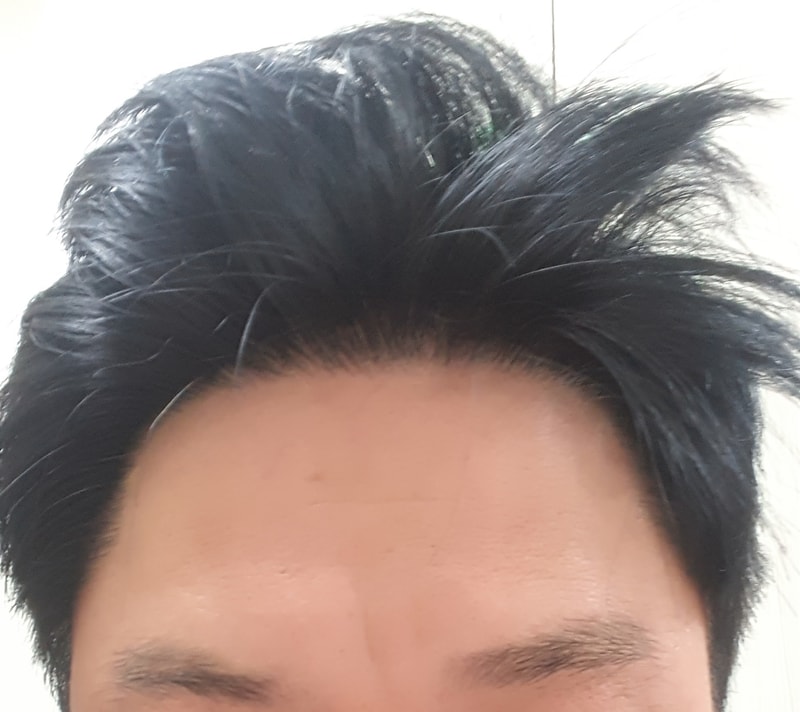 모발이식 2년 올림머리.jpg