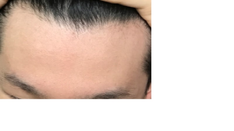 탈모10.png