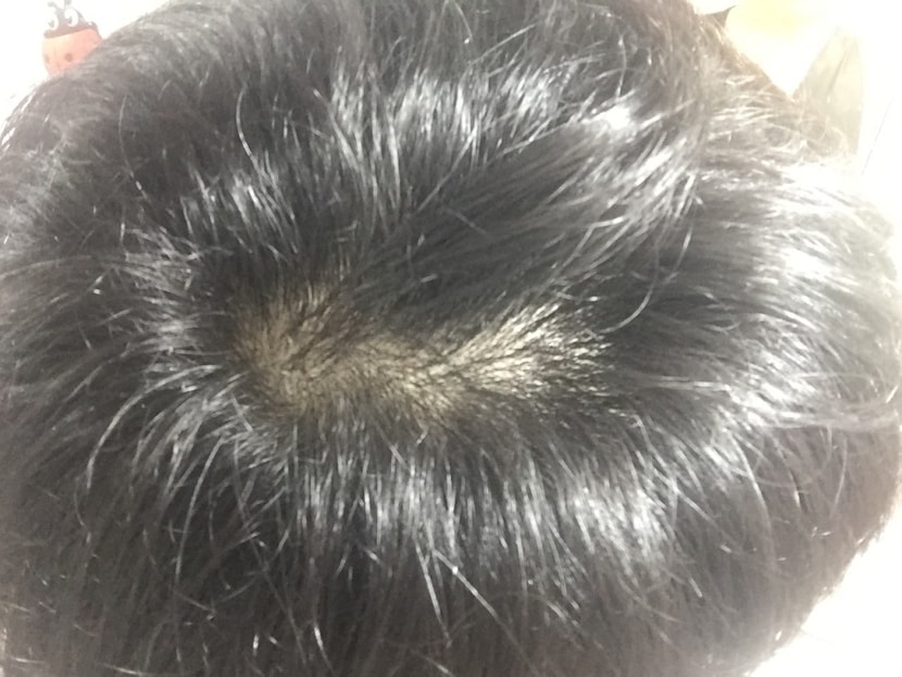 방금 찍은 정수리 부분에 애매하게 살아있는 부분 기준 오른쪽