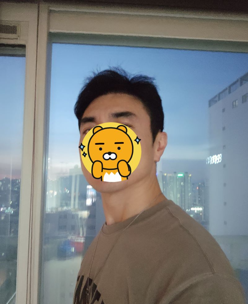 부산남자 모발이식 8개월차입니다