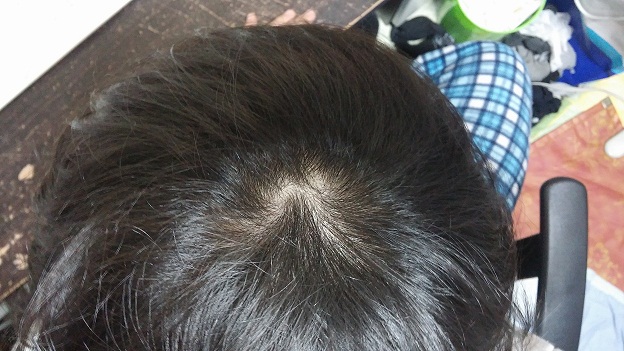 정수리.jpg