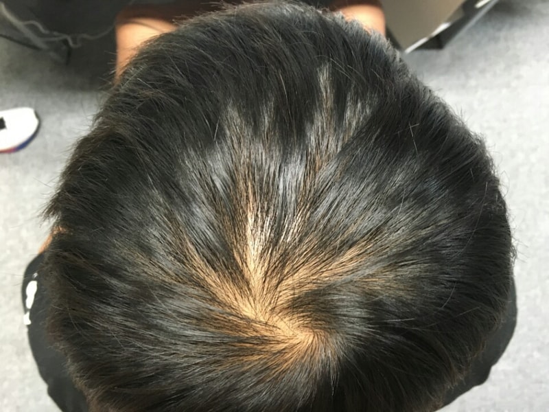 탈모3.jpg