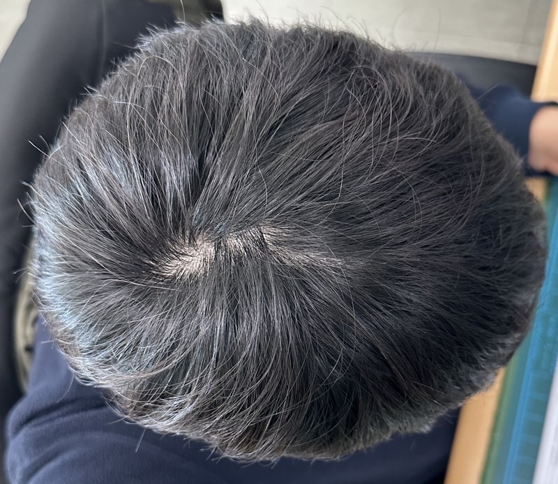 탈모일까요??