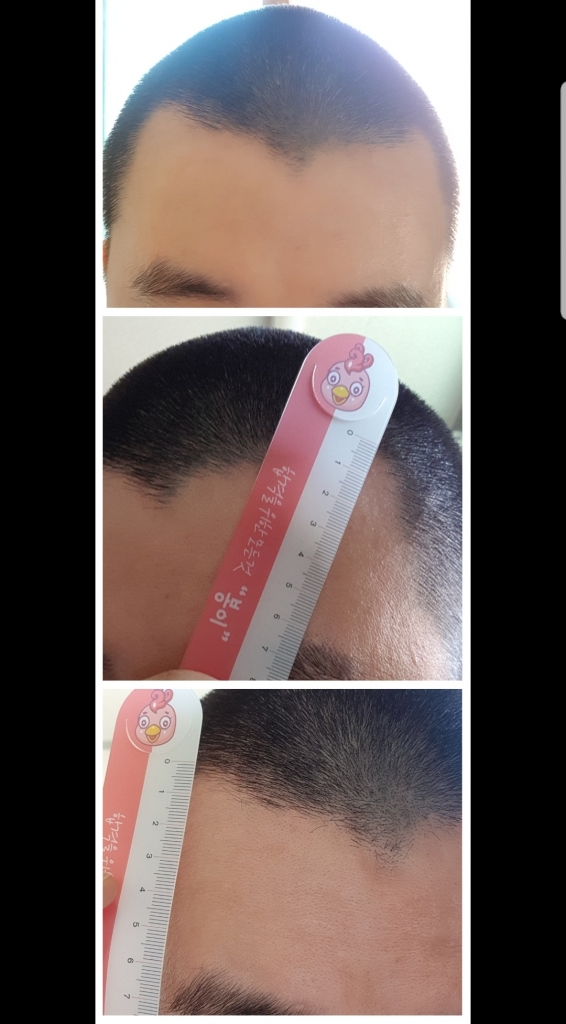 m이마교정.jpg