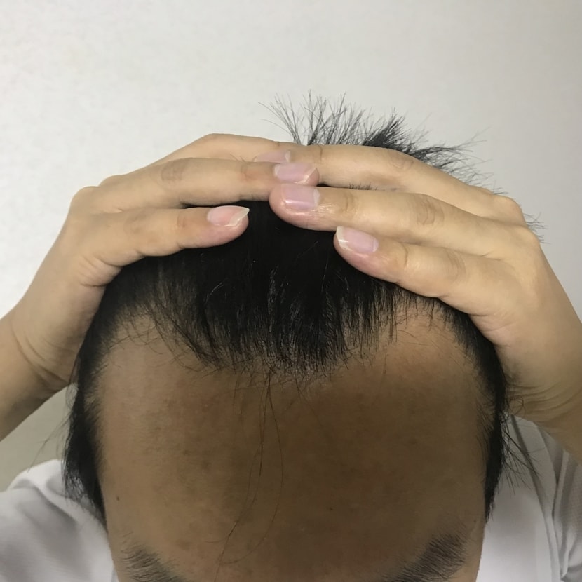 엠자형 탈모시작..