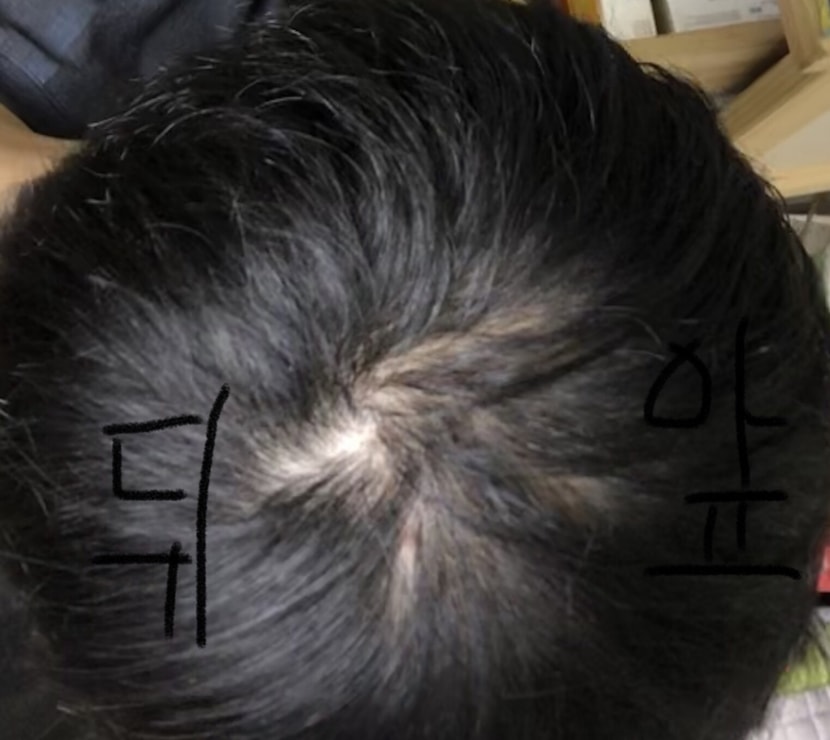 미녹뿌린뒤 뒤에 확인해봣는데 라인이 생겼더군요 ㅠㅠ