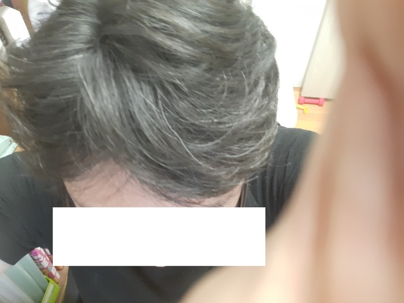 탈모2.jpg