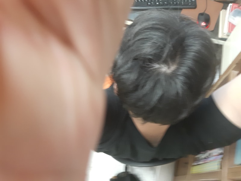 탈모1.jpg