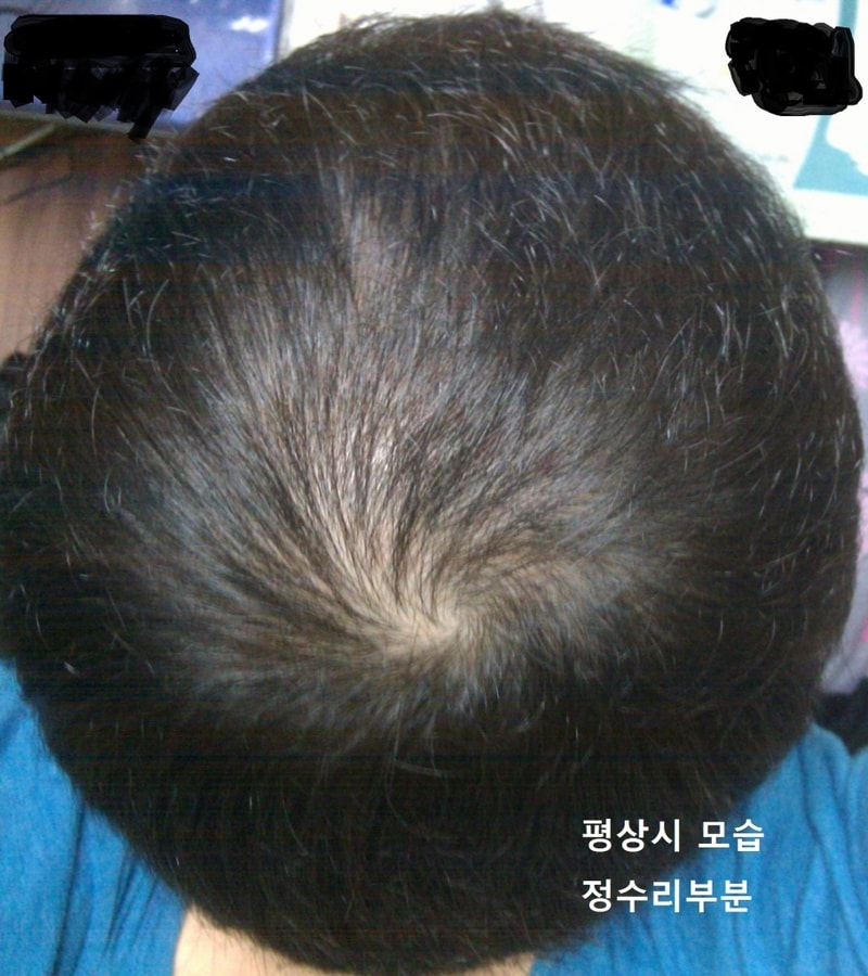 올릴파일 정수리 평상시.jpg