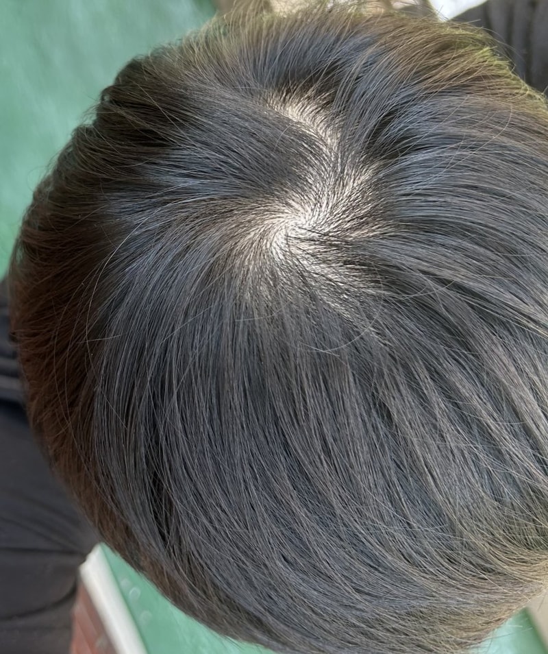 alopecia-20230602-224041-000-resize.jpg