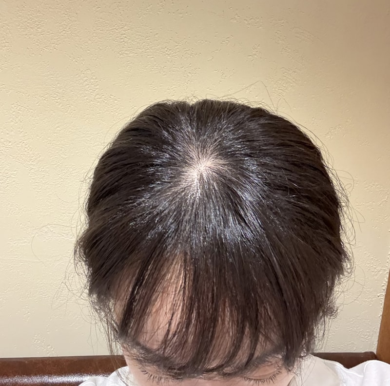 35세 여, 탈모초기일까요…?