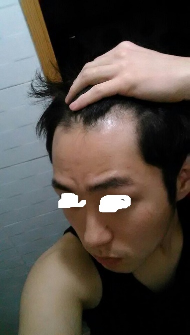 이식 전