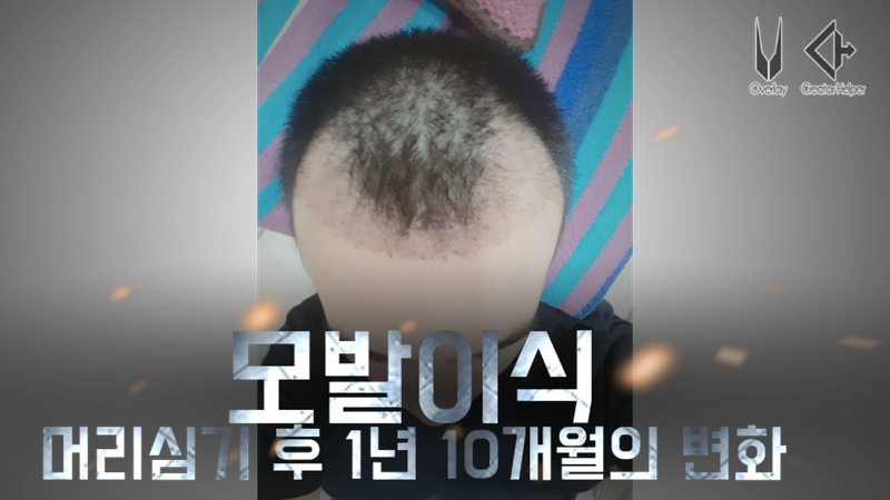 모발이식.png