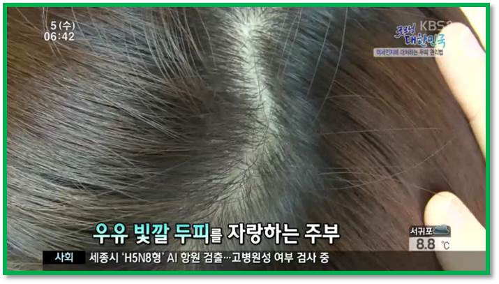 건강한두피사진
