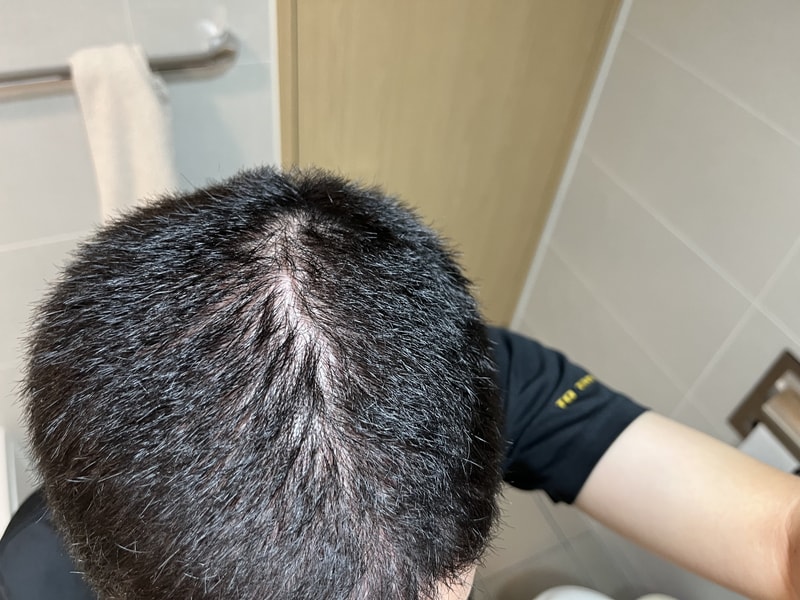 탈모 인가요?