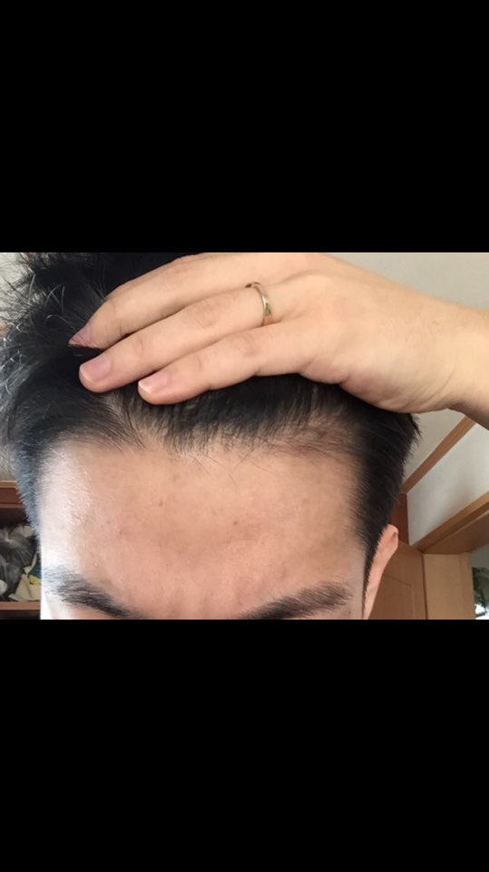 이게 올 초에 찍은 이마 사진