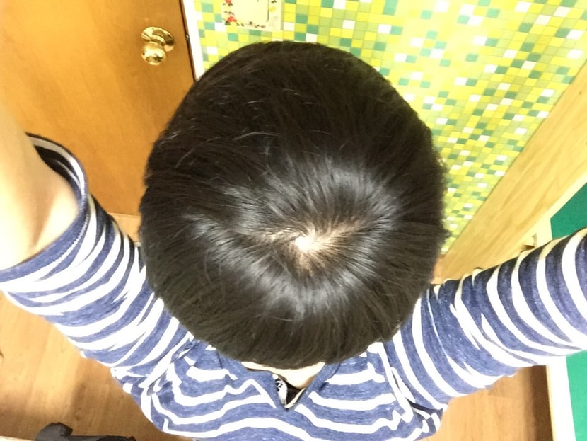 올 초 정수리 1