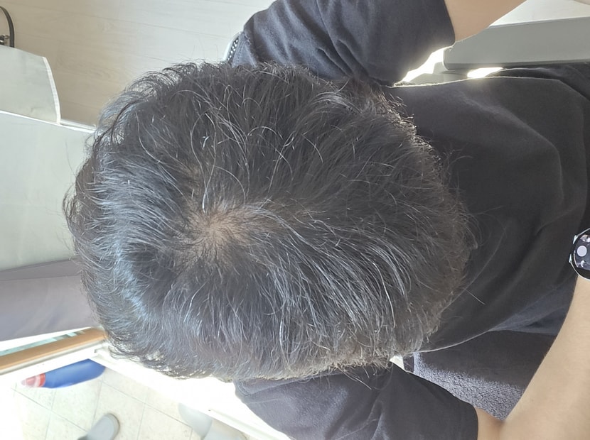 정수리 부분이 젤 심하고 곱슬기때문에 잘 안보이는데 가르마 부분들도 라인이 다 보입니다