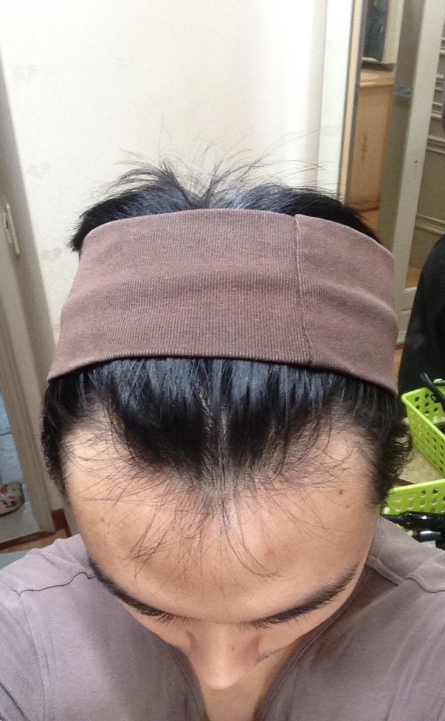 모발이식2.jpg