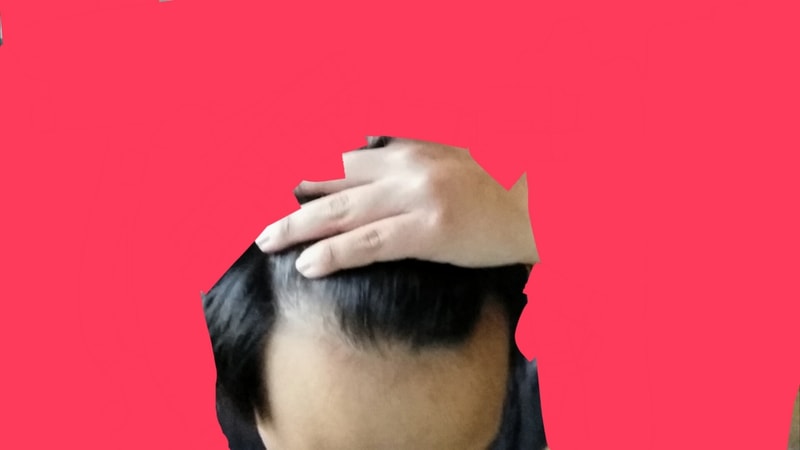탈모1.jpg