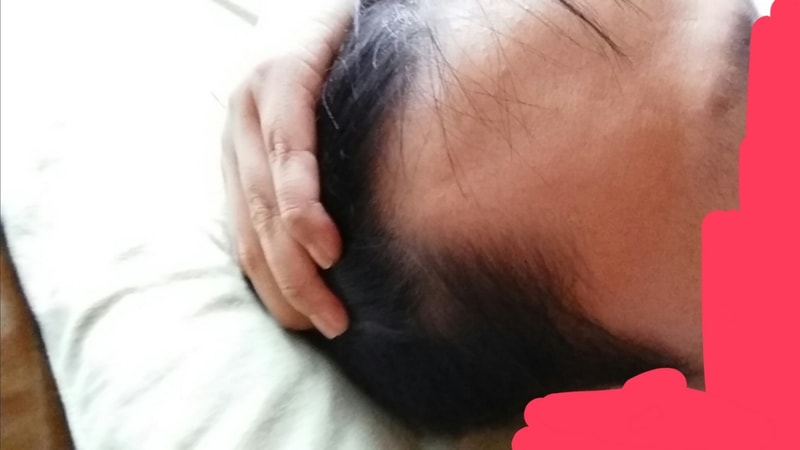 탈모3.jpg