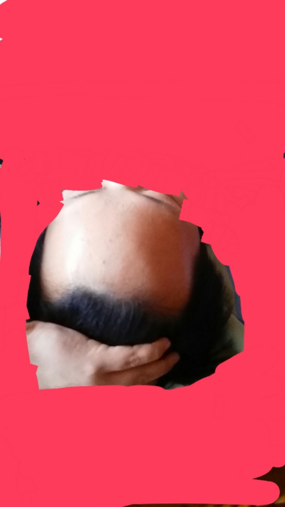 탈모2.jpg