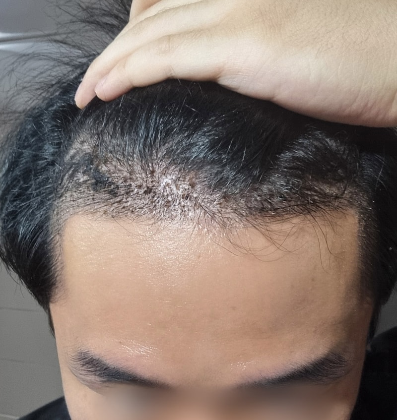 권범준_모발_240621_수술후1주_1.jpg