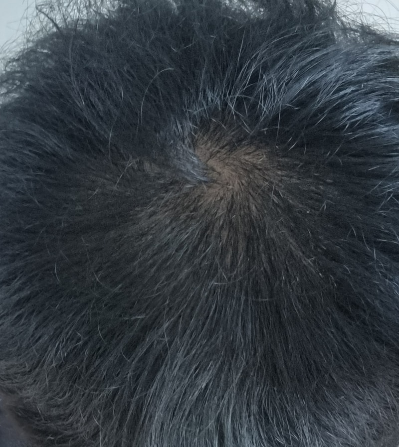 21 years old, is it diffuse hair loss?