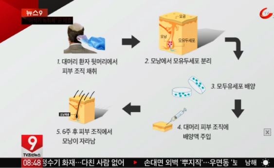탈모치료.JPG