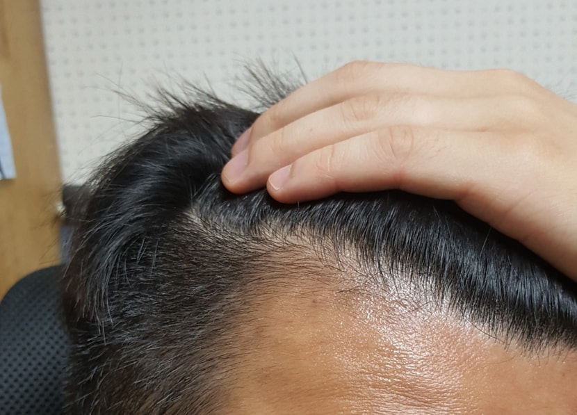 아보다트 복용 2달 경과 사진입니다.