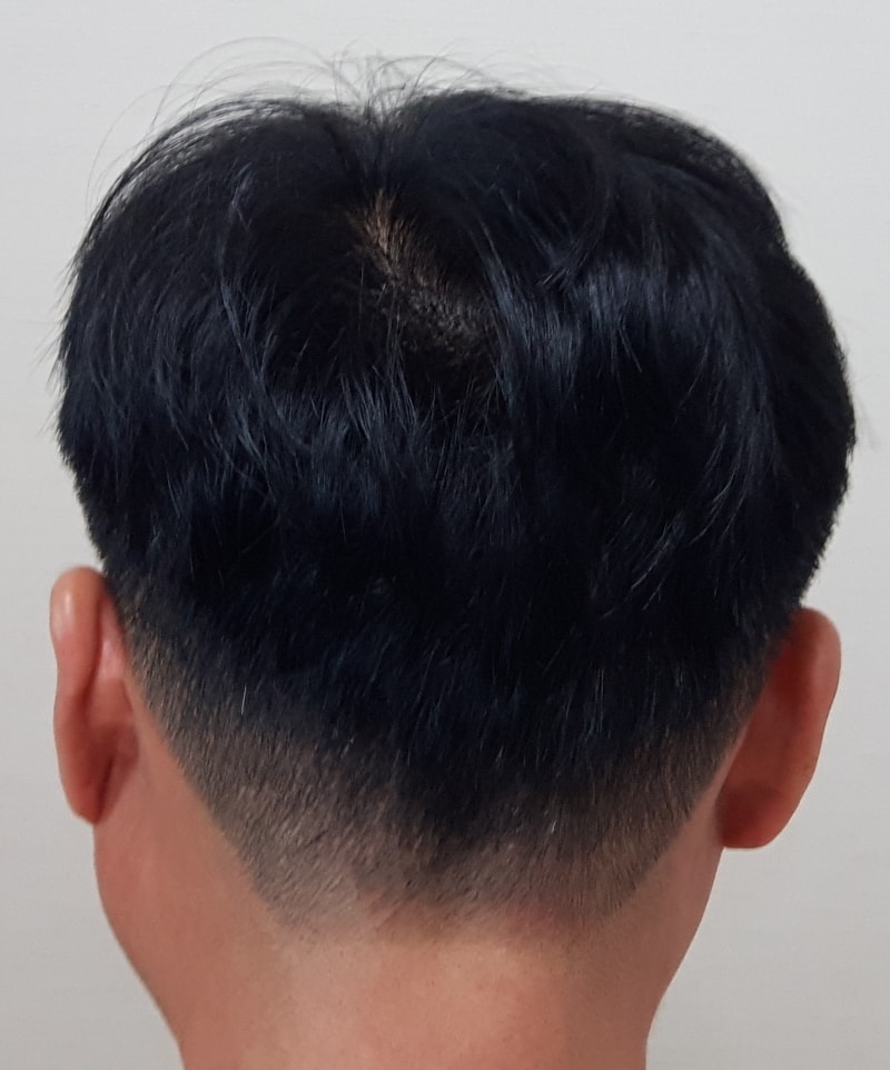 뒷머리 흉터이식 부분.jpg