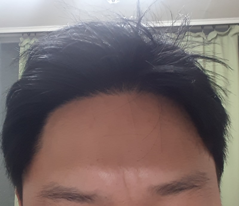 로게인폼 2개월 3주.jpg