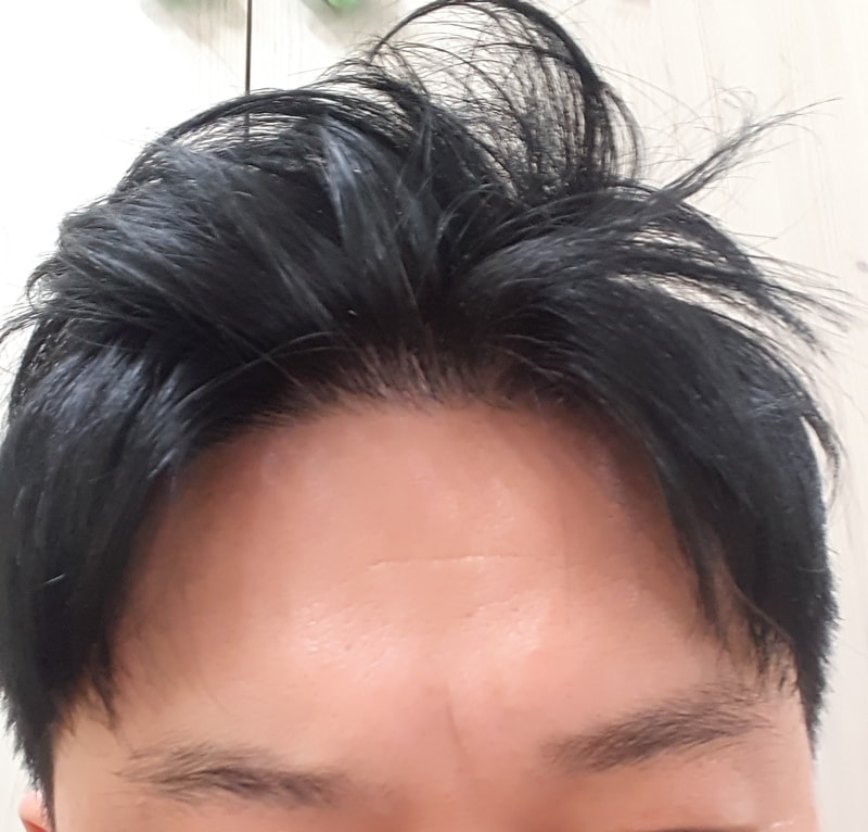 모발이식 1년 6개월.jpg