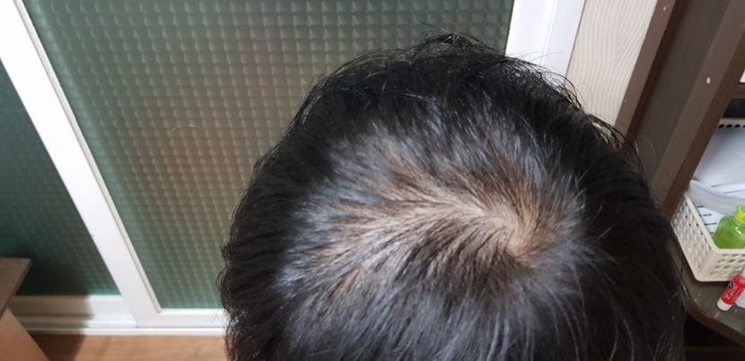 일주일전 윗머리 걷어내고 찍은 사진